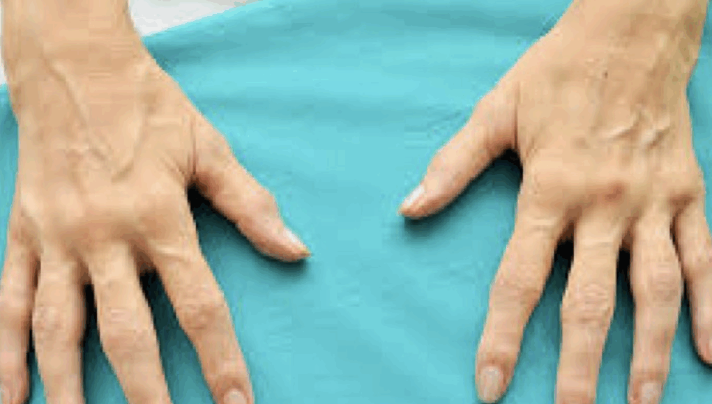 prirodni lijek za artritis