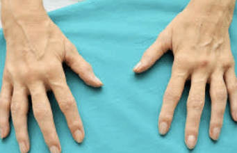 Šta je artritis i kako ga liječiti na prirodan način prirodni lijek za artritis