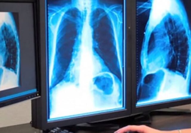 Ove dvije navike glavni su krivci za većinu karcinoma koji se mogu spriječiti