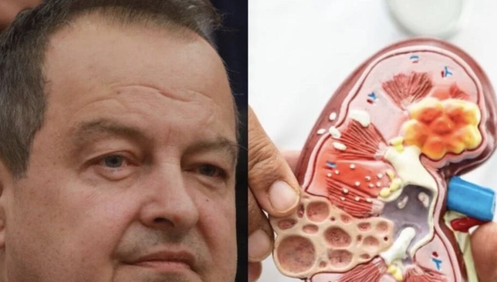 Ivica Dačić ne boluje samo od upale pluća, ovu bolest je ignorisao godinama, a tiho razara organe