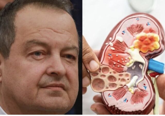 Ivica Dačić ne boluje samo od upale pluća, ovu bolest je ignorisao godinama, a tiho razara organe
