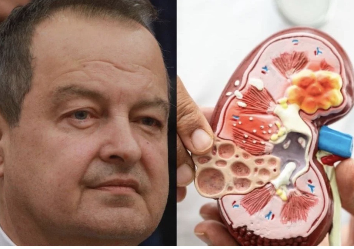Ivica Dačić ne boluje samo od upale pluća, ovu bolest je ignorisao godinama, a tiho razara organe